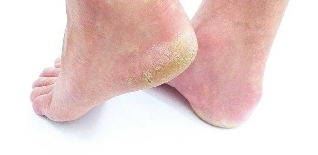 Heel Pain